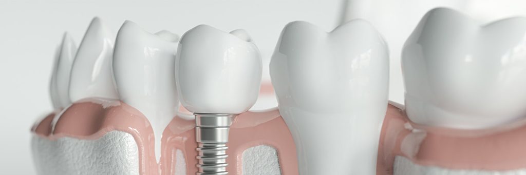 Implantatprothetik Gebiss
