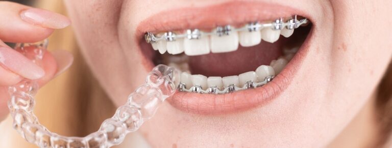 Schiefe Zähne? Diese Behandlungsmöglichkeiten gibt es!